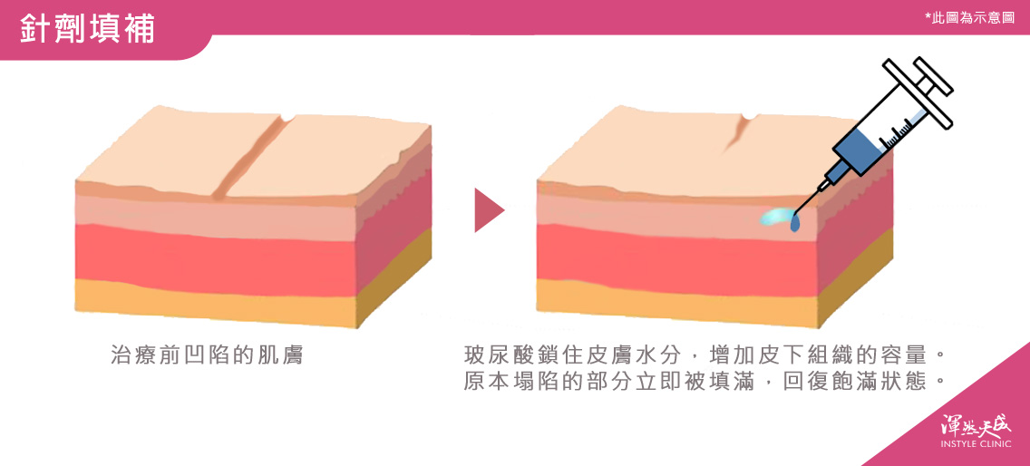 針劑填補 針劑填補